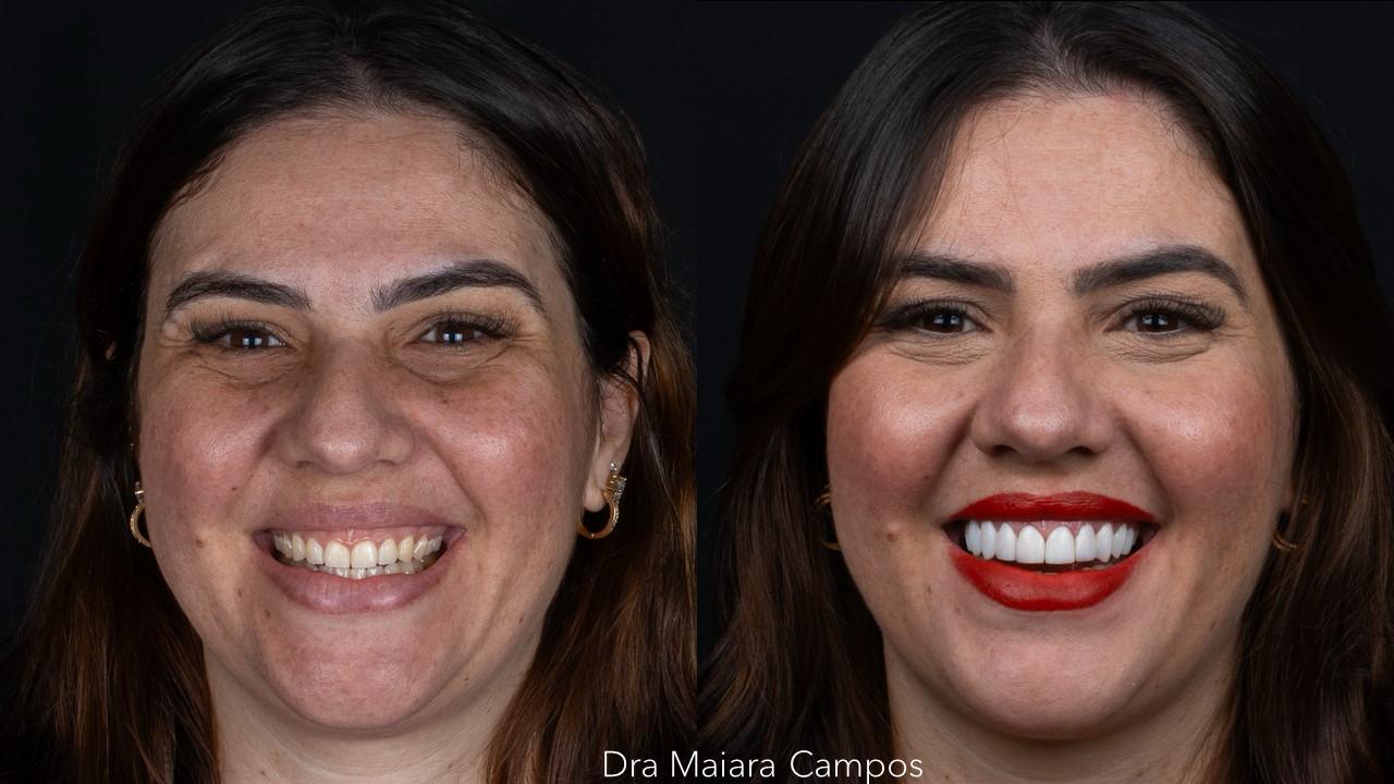 antes e depois